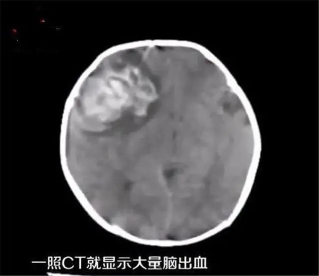 8. 广东清远孕妇因旧俗不吃青菜 多名婴儿突发脑出血广东清远的一个女婴欣欣（化名），因为突发脑出血进了医院